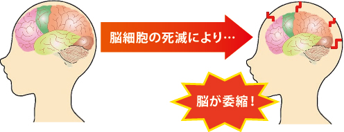 脳細胞の死滅により…脳が委縮! 脳細胞の死滅により…脳が委縮!